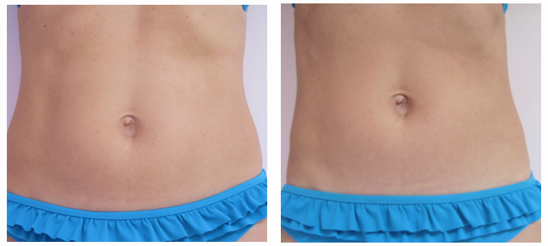 wrap-avant-apres-face